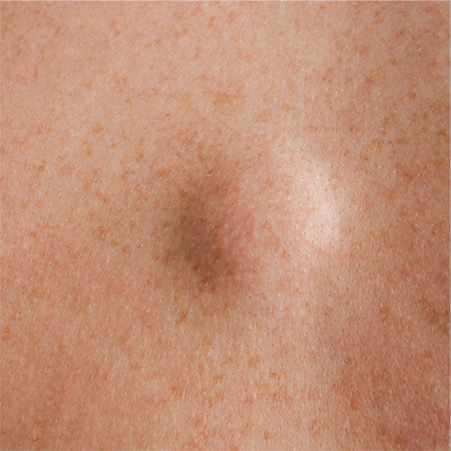 Fatty tumors lipomas